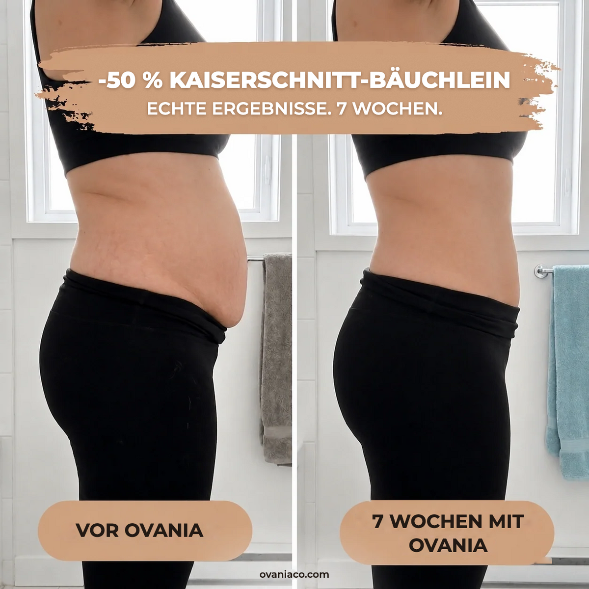 -50 % Kaiserschnitt-Bäuchlein